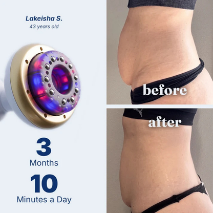 ORBE - Anti-cellulite Massager