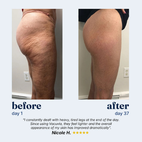 ORBE - Anti-cellulite Massager